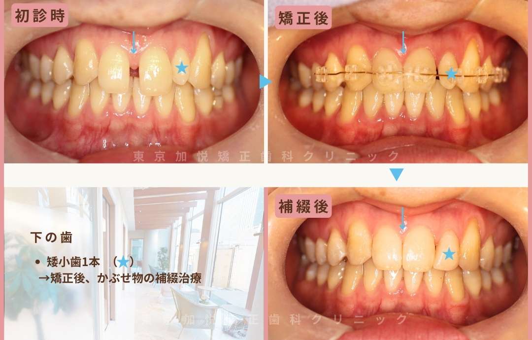 下の歯。矮小歯1本。矯正後かぶせものの補綴治療