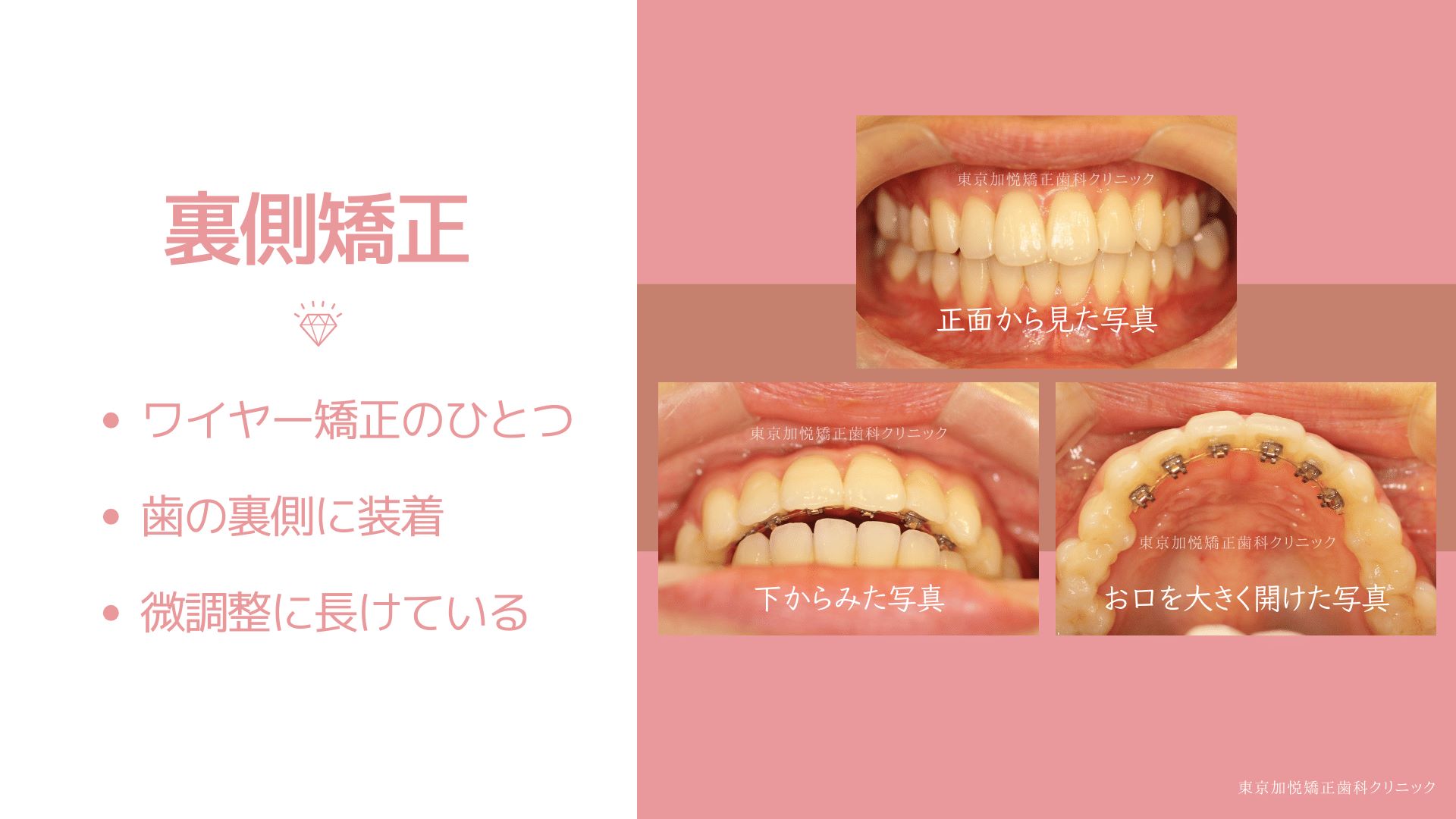 ワイヤー矯正の一つ、歯の裏側に装着、微調整に長けている