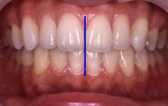 歯の正中（多い線）が顔の正中に一致