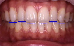 歯の切端ライン（青い線）がバランスよく並ぶ