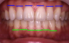 歯肉部ラインが（青い線・緑の線）がバランスよく並ぶ