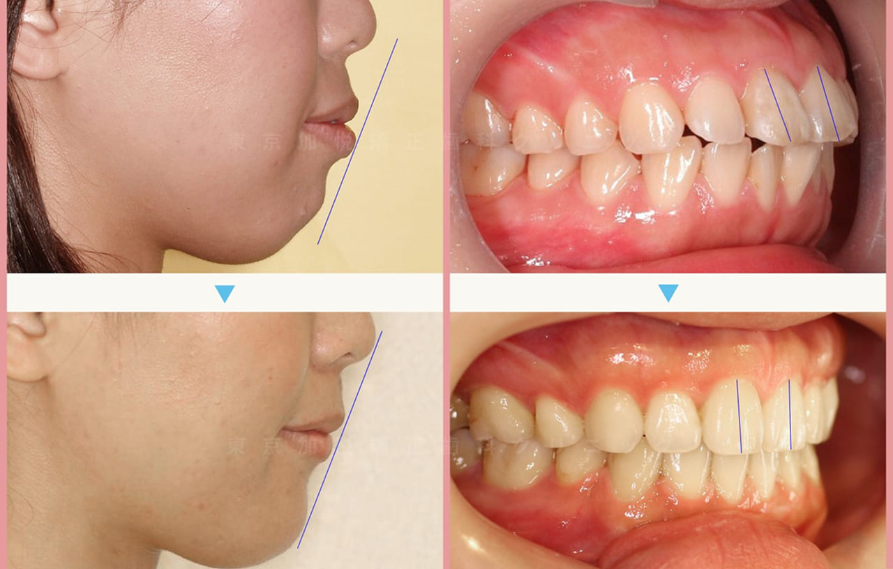 裏側矯正・全顎