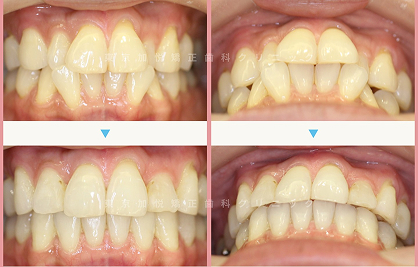 コンビネーション矯正・前歯のみ