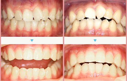 表側矯正・前歯のみ