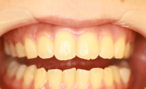 上の前歯を矯正した後