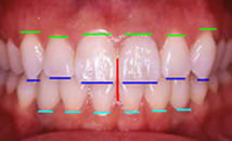 ミリ単位の精密な咬合治療 before