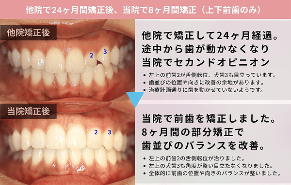 途中から歯が動くなってしまった
