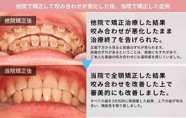 咬み合わせが悪化したまま治療終了を告げられた
