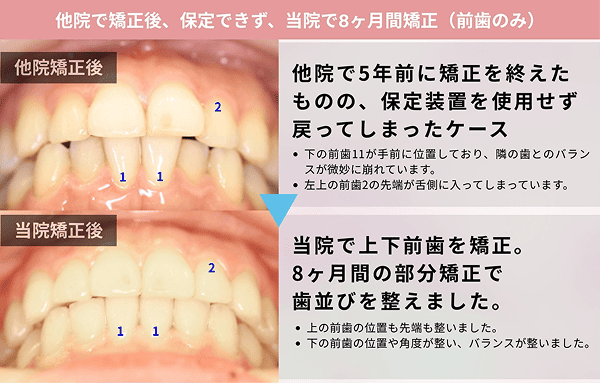 5年経ったら歯並びが戻ってしまった