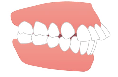 出っ歯・前突の矯正