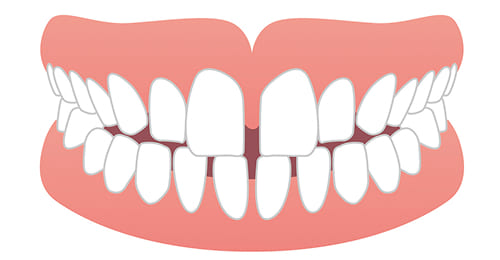 すきっ歯の矯正