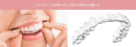 マウスピース矯正