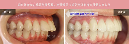 歯を抜かない歯科矯正