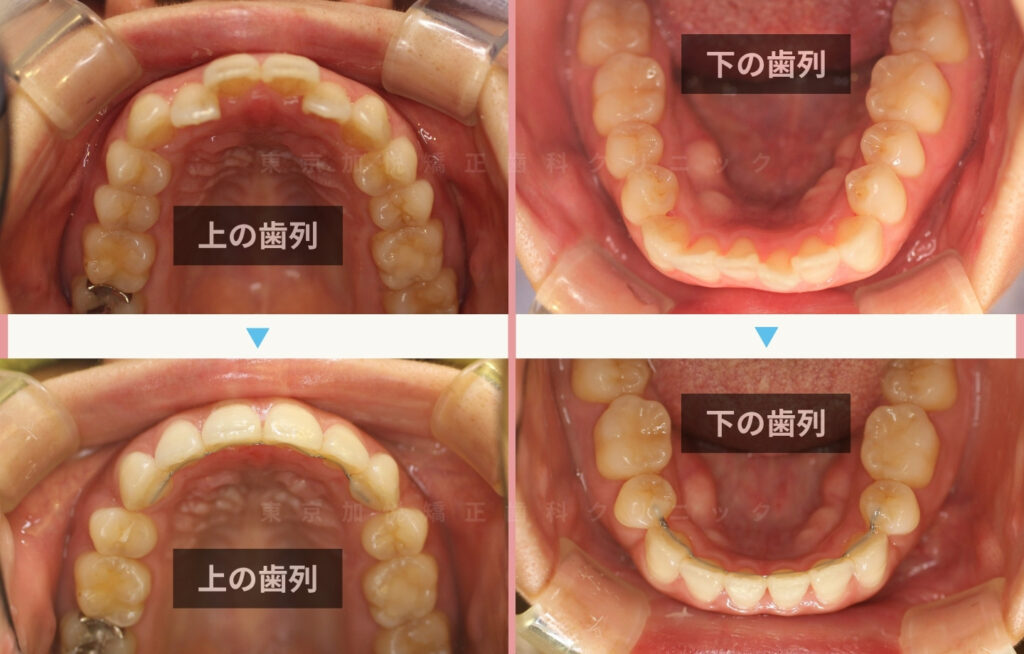 口ゴボを12ヶ月間の矯正治療で改善した咬合面の治療前後写真