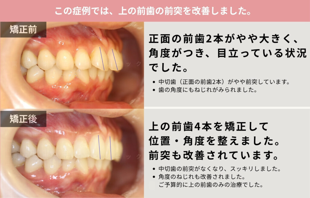 6ヶ月間で上の正面前歯が大きいのを改善した治療前後の解説画像