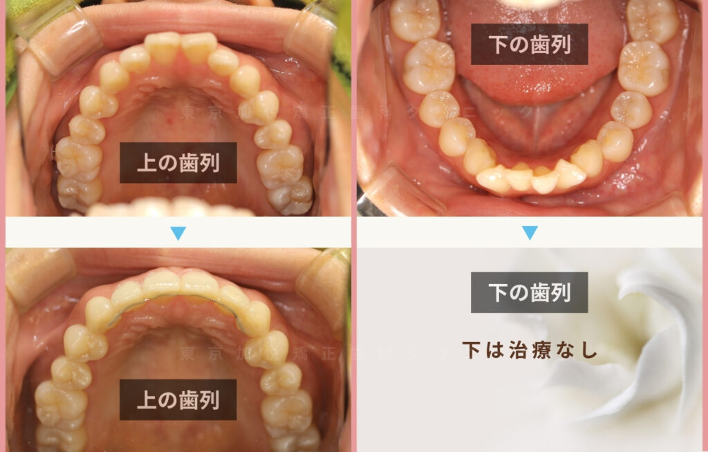 6ヶ月間で正面前歯が大きいのを改善した前歯治療前後の咬合面写真