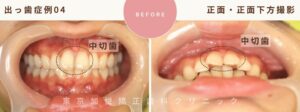 前歯（中切歯）が大きいのが気になる