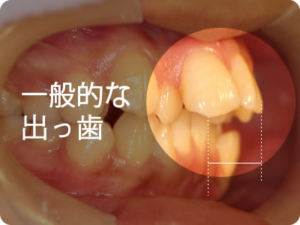 一般的な出っ歯