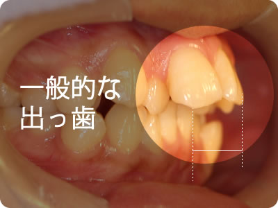 出っ歯タイプ診断 5秒でできるセルフ診断と治療紹介 東京加悦矯正歯科クリニック