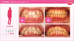 歯を抜かずに八重歯の部分矯正治療をした症例