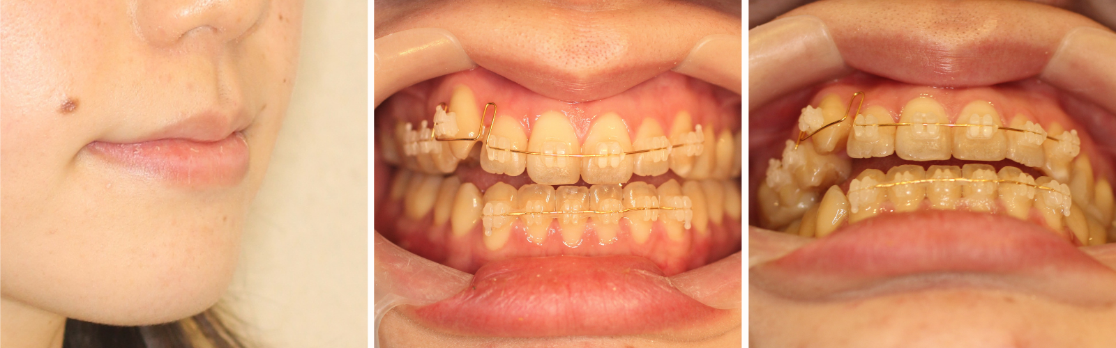 八重歯治療中の写真