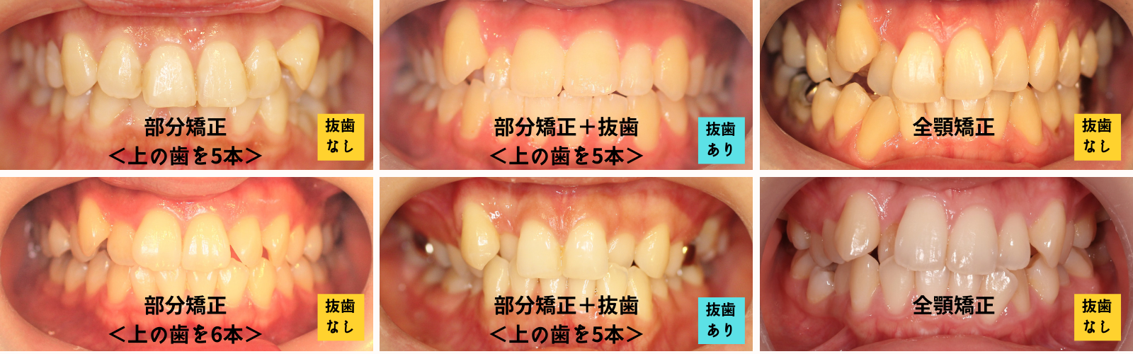 八重歯治療の選択肢