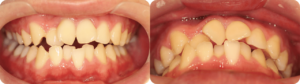 上の前歯が羽のように傾いてしまうケースです。上下の前歯がクロスしてしまっている箇所もあります