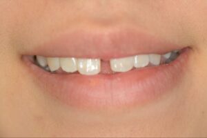 すきっ歯を補綴で治療した症例