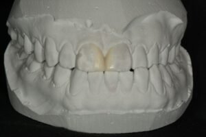 すきっ歯のモデルに補綴物を入れた治療イメージ