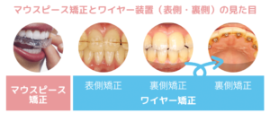 マウスピース矯正とワイヤー矯正の見た目の違い