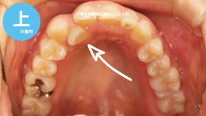 舌側転移の歯並び