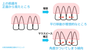 上の前歯を正面から見たところ。理想は平行移動。マウスピース矯正は角度がついてしまう傾向