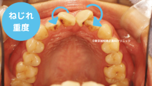 重度に前歯がねじれた症例