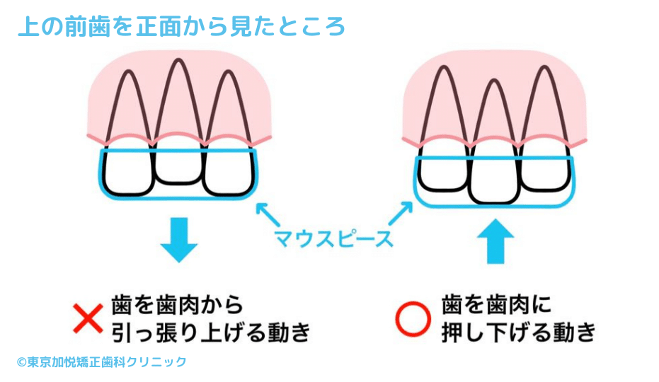 上の前歯を正面から見たところ。歯を歯肉に押し下げる動き。