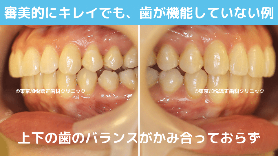 審美的にキレイでも、歯が機能していない例。横写真。上下のはのバランスが噛み合っておらず。