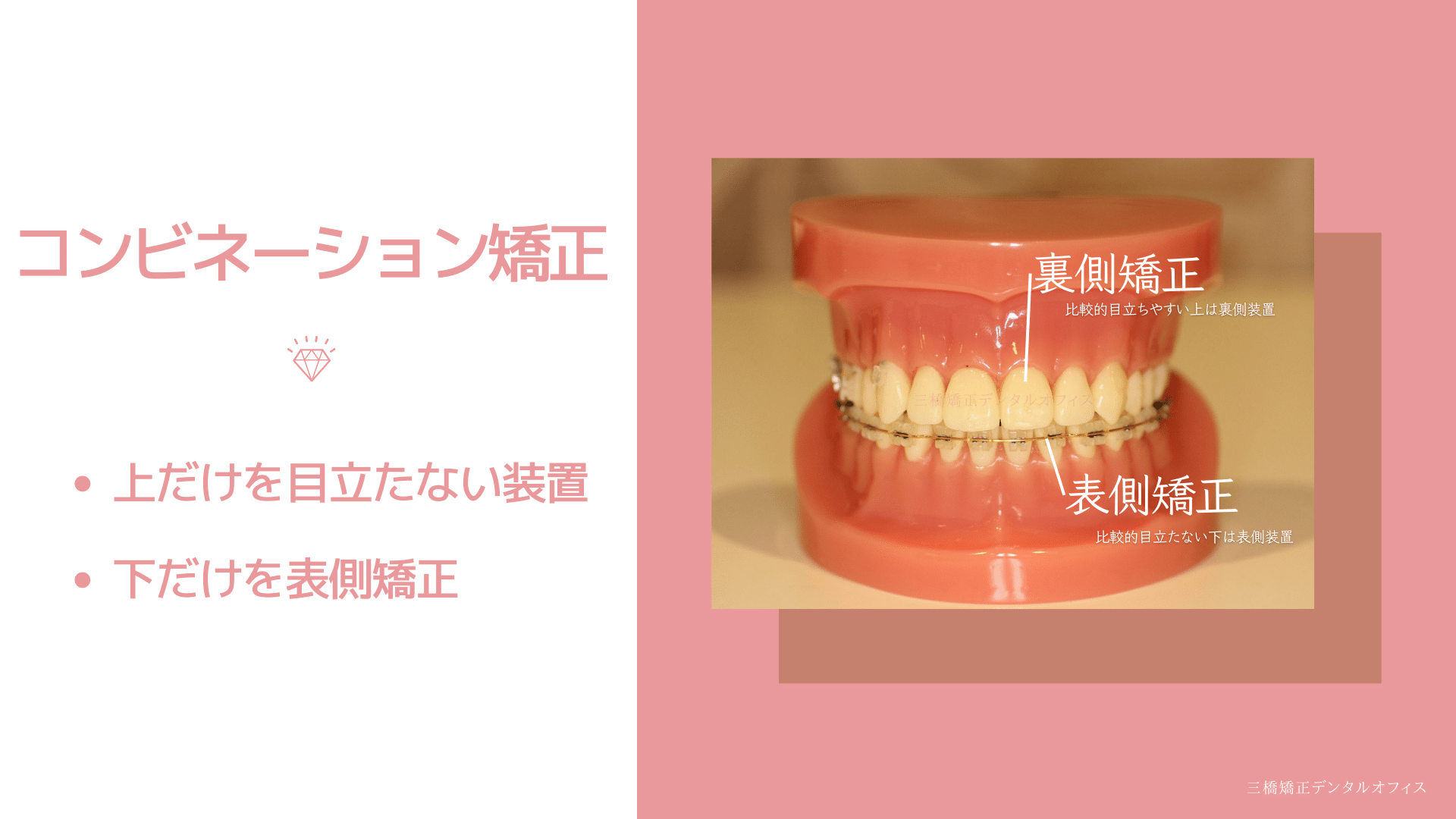 コンビネーション矯正の特徴