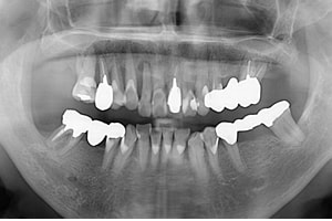 歯の噛み合わせが悪いままだと、虫歯や歯槽膿漏で歯を失うリスクが高まります。