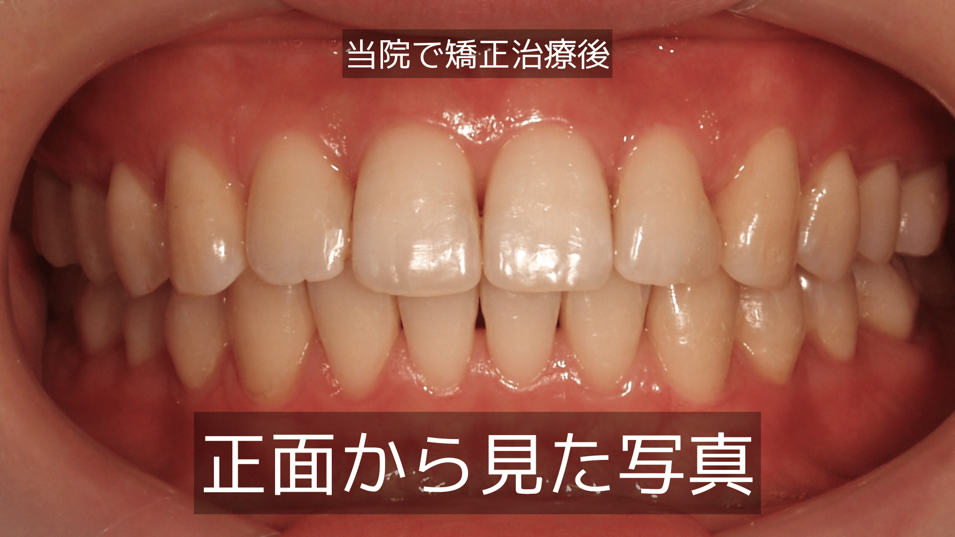 歯 の 噛み 合わせ 正しい 位置