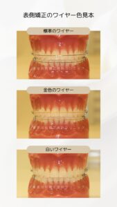 表側矯正のワイヤー色見本