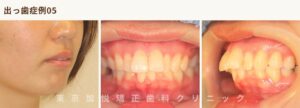 出っ歯の矯正（治療前の状態）