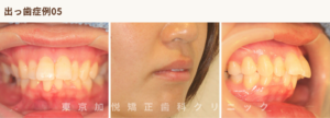 出っ歯の方の写真