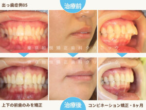 出っ歯を部分矯正で治療した前後写真