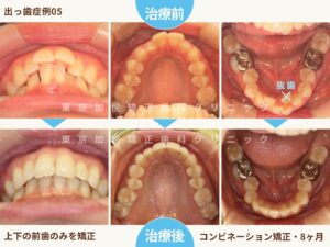 出っ歯の矯正（治療前後咬合面の写真）