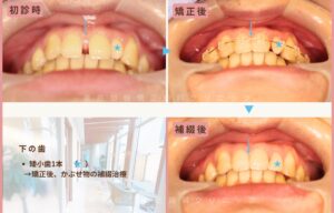 すきっ歯・矮小歯・欠損歯の治療前写真（正面下から写真）