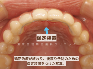 保定装置