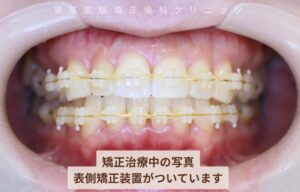 矯正治療中の写真 表側矯正装置がついています