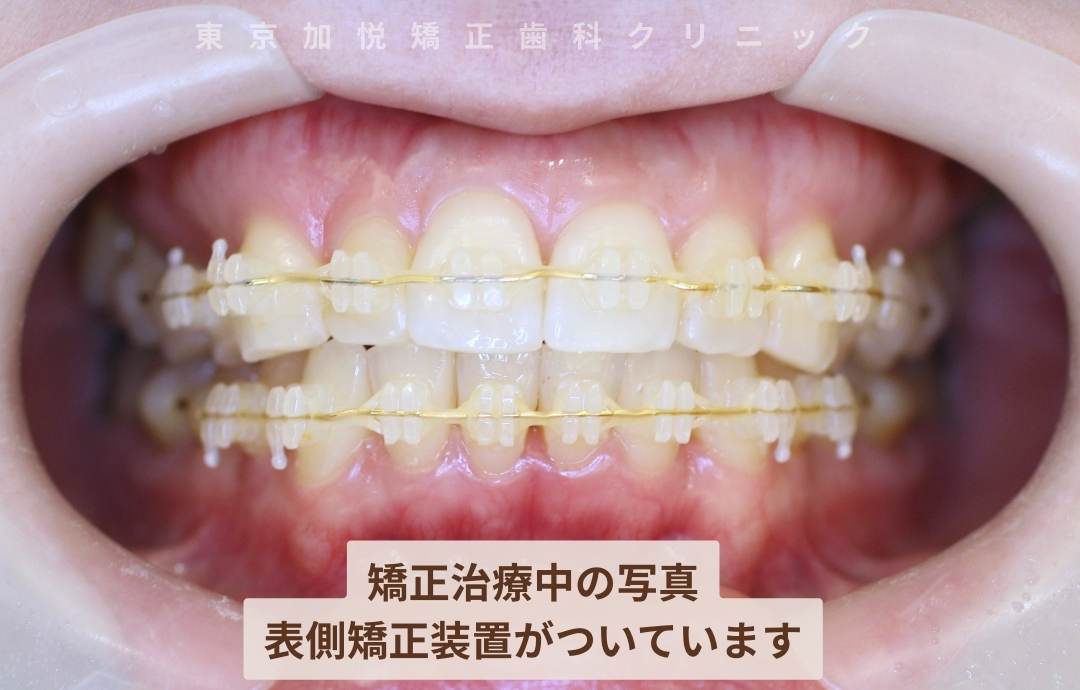 矯正治療中の写真
表側矯正装置がついています