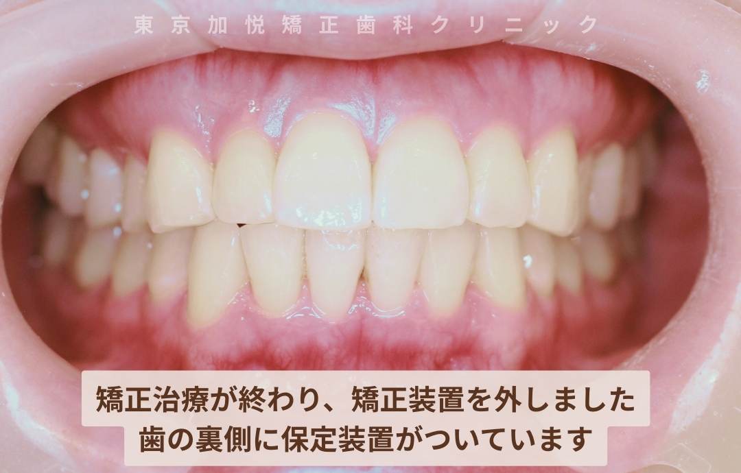矯正治療が終わり、矯正装置を外しました
歯の裏側に保定装置がついています