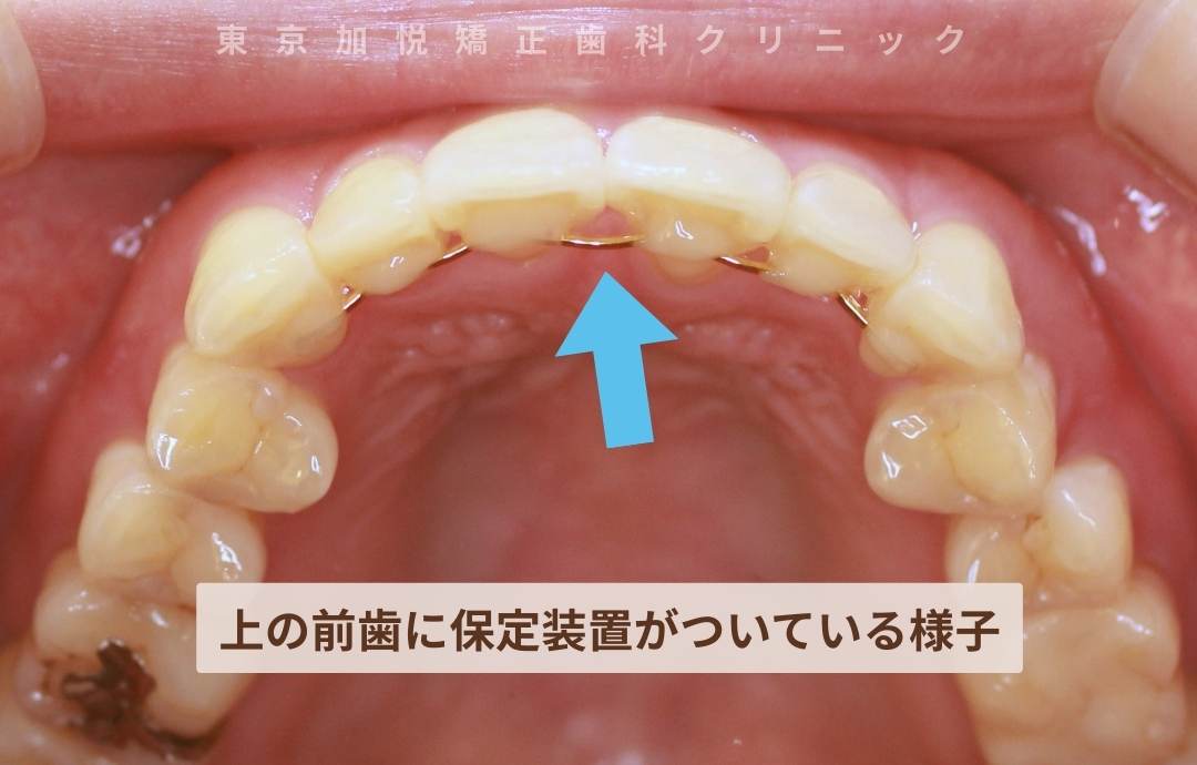 上の前歯に保定装置がついている様子