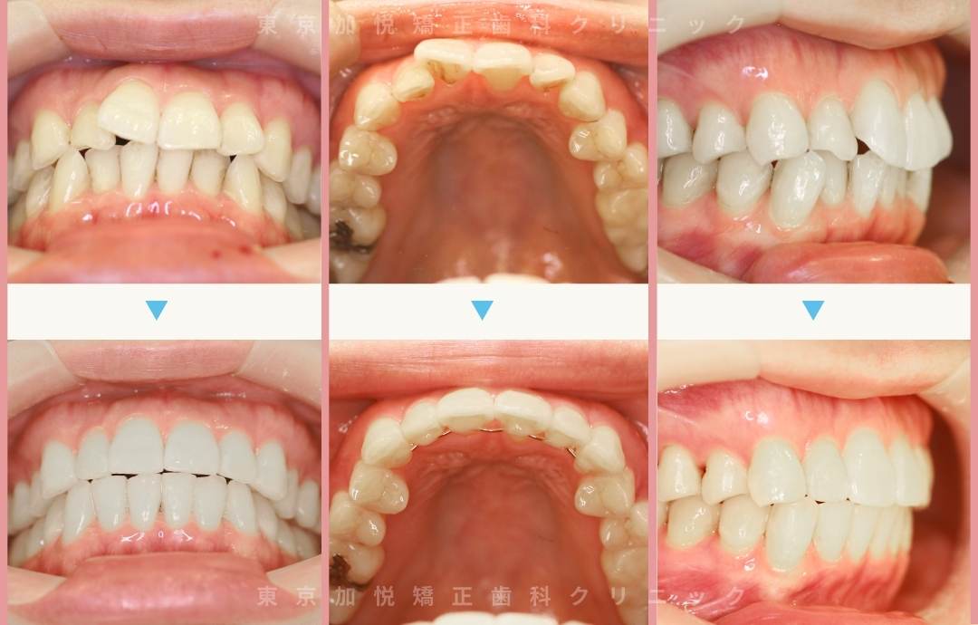 叢生の症例。上下の前歯のみを矯正した前後の写真
